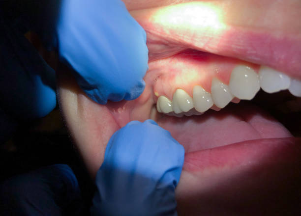 Best Urgent Care for Lost Fillings or Crowns in Lakeland North, WA